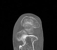 Navicular fracture 2