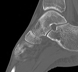 Navicular fracture