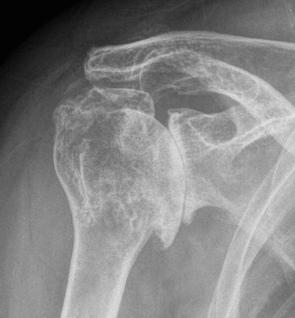 Shoulder OA post trauma