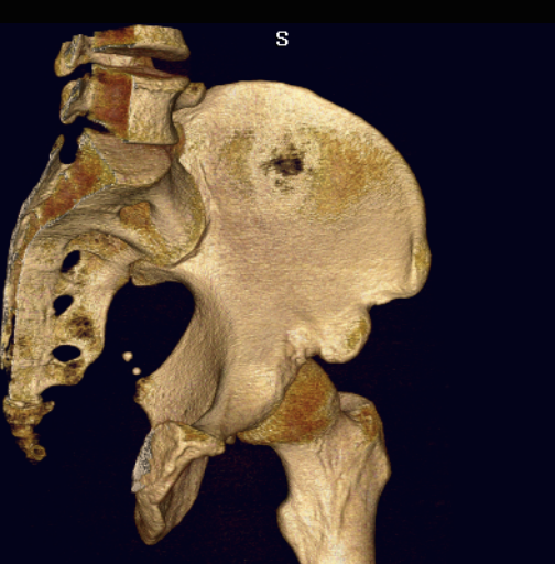 Subspine impingement 2