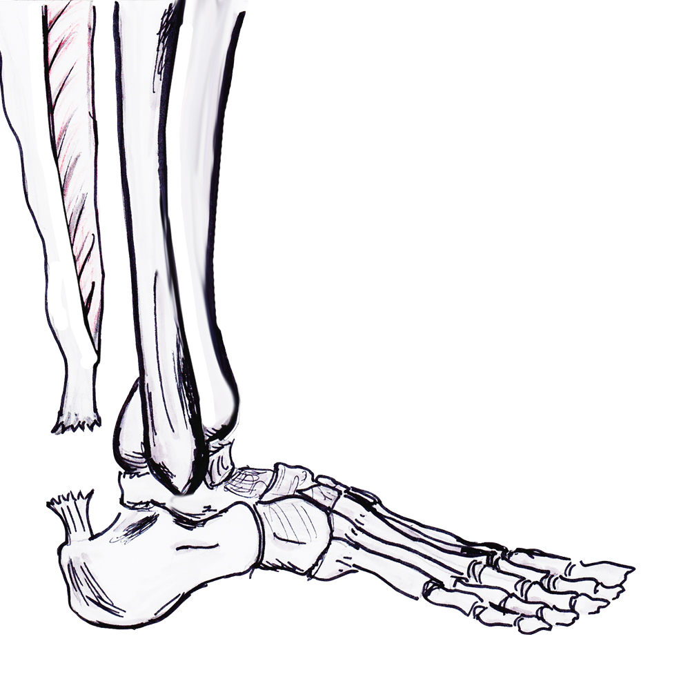 Achilles tendon rupture