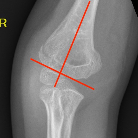 Baumanns angle paediatric elbow