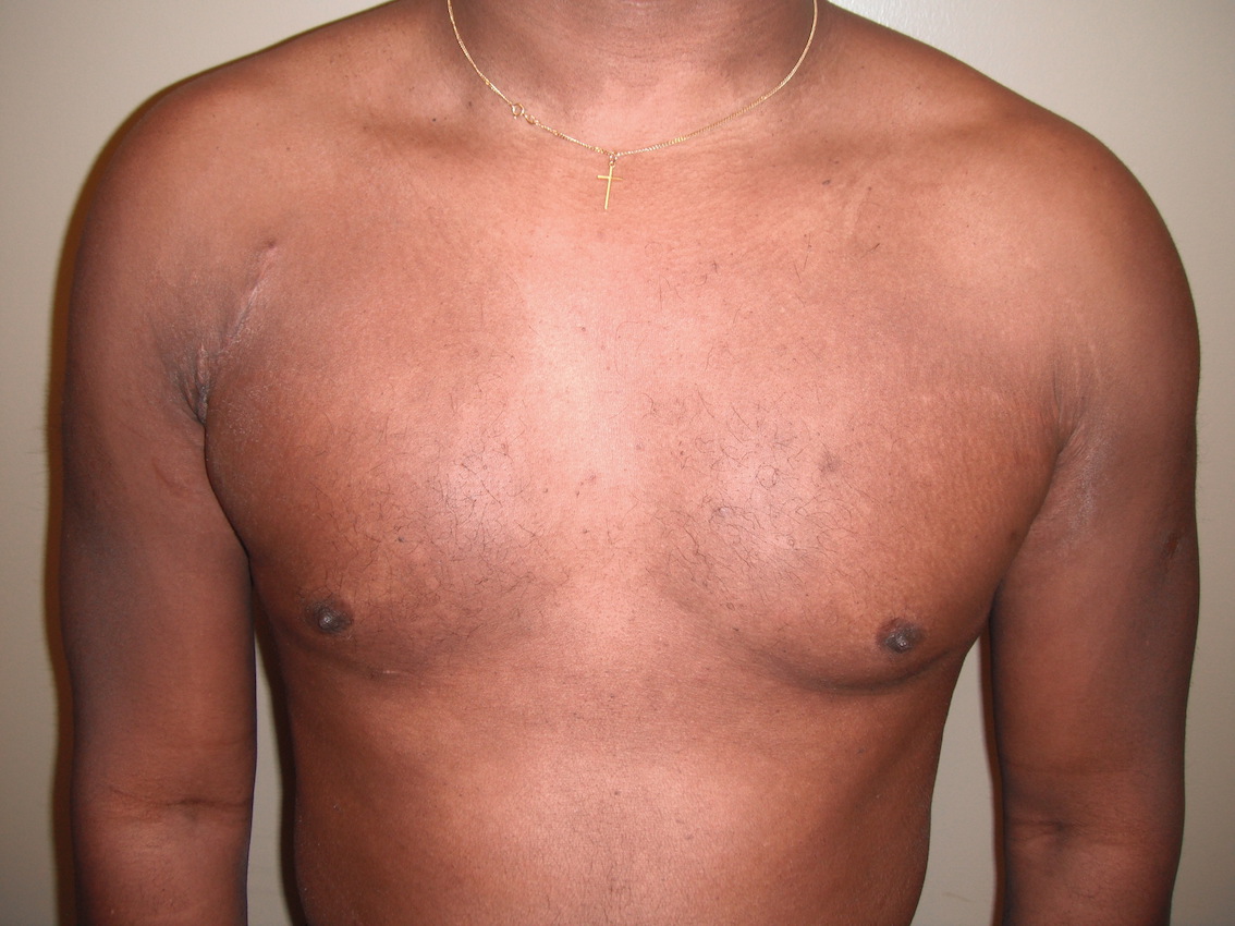 Incision Pec Major Repair