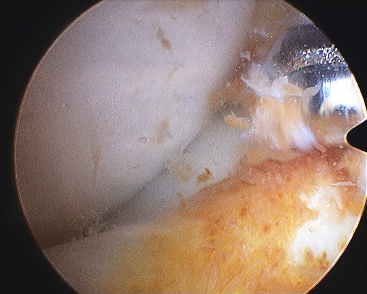 PVNS debridement knee