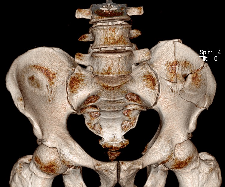 Ileum Fracture