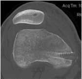 Femoral Fixaiton MPFL