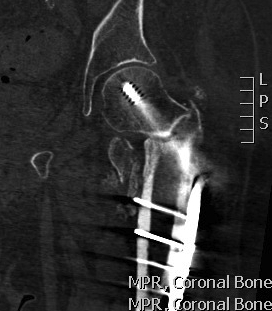 NOF Intertrochanteric Nonunion CT