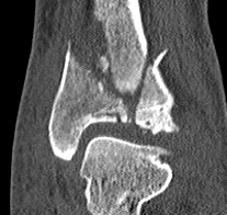 Tibial Plafond CT Axial