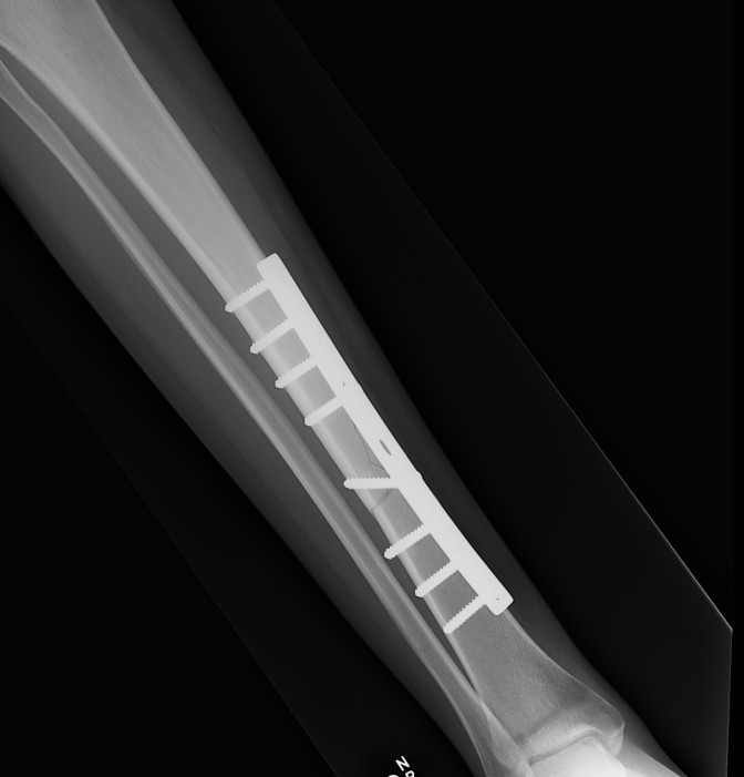 Tibial Midshaft Plate