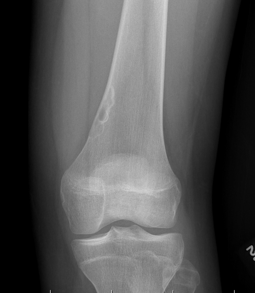 Non Ossifying Fibroma