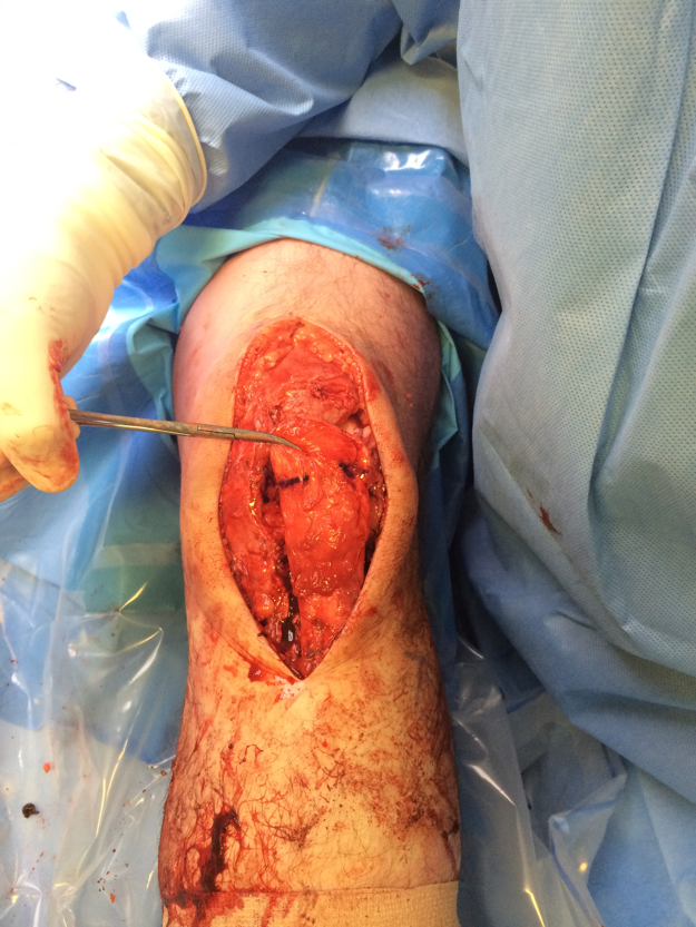 Chronic patella tendon rupture Hamstring Recon