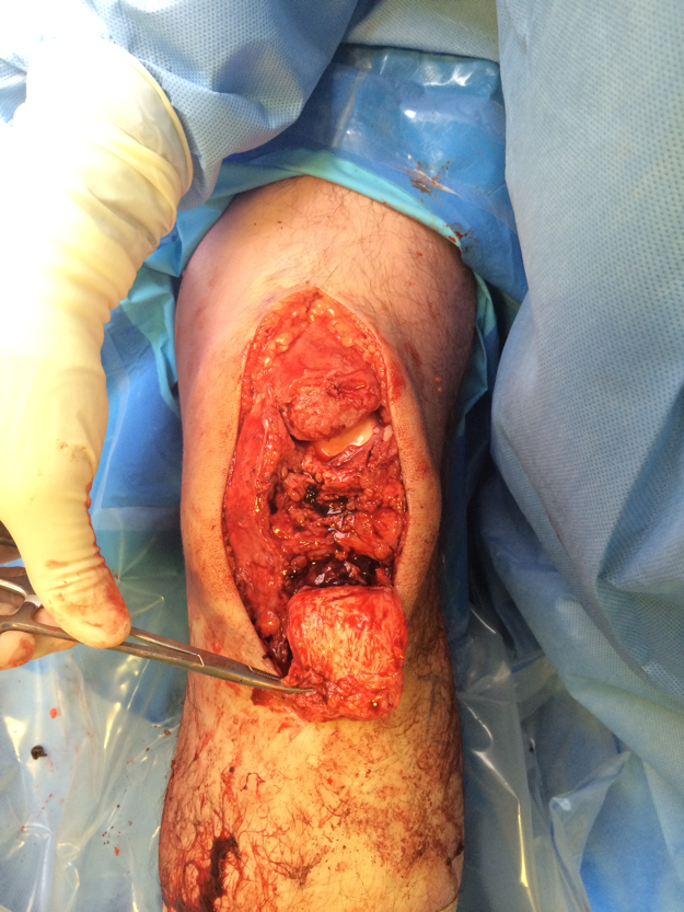 Chronic patella tendon rupture Hamstring Recon