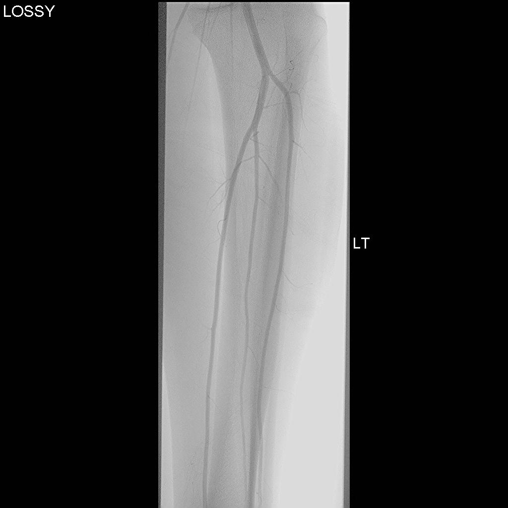 Angiogram Normal 2