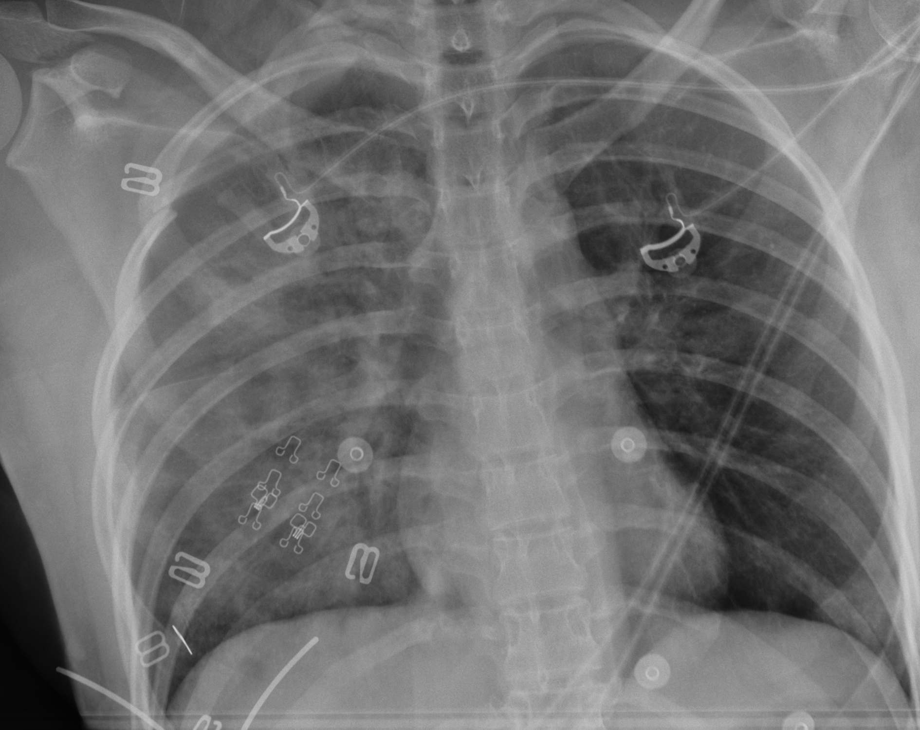 Hemothorax