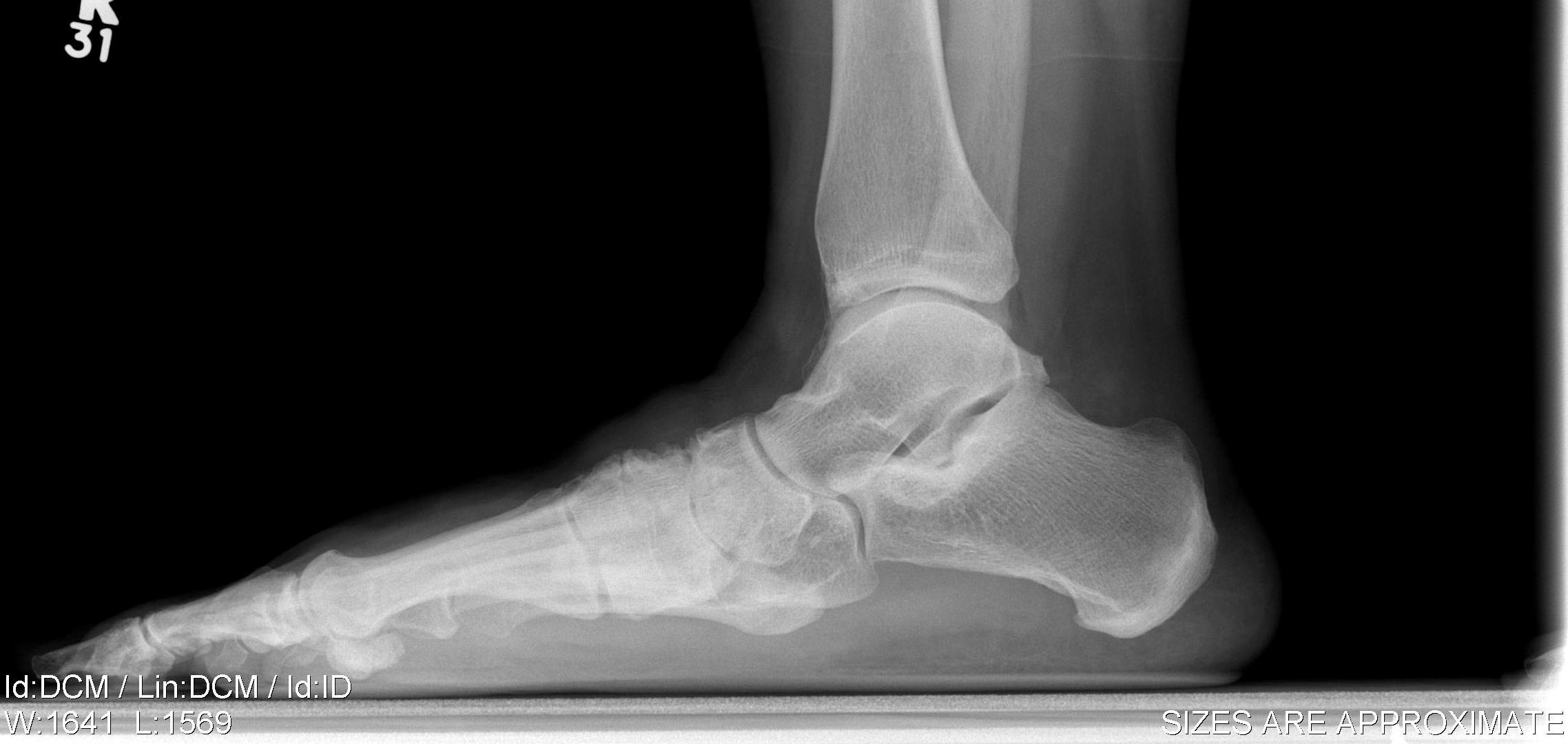 Planovalgus Lateral Xray