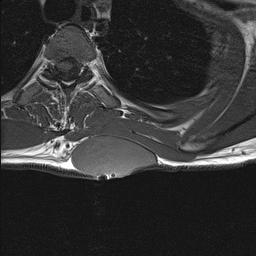 Fibrosarcoma