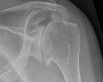 Shoulder OA Xray