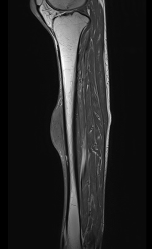 Tibial sarc 2