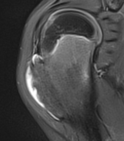 OC Humerus MRI 2