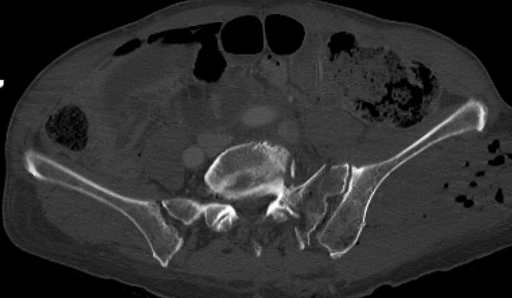 LC1 sacral fractures