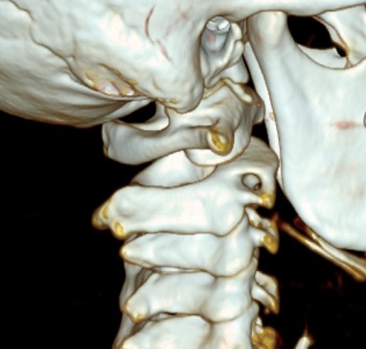 Atlantoaxial 3D CT