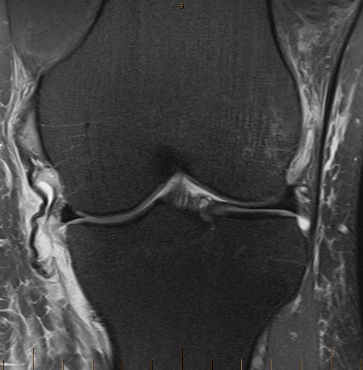 MCL tibial avulsion 1