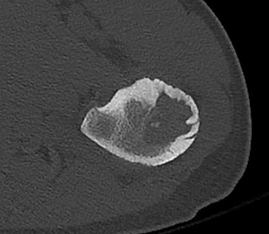 Osteoblastoma CT 2