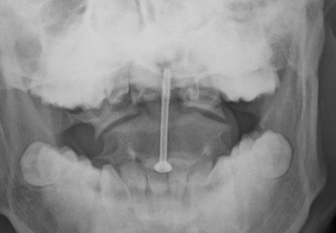 odontoid screw