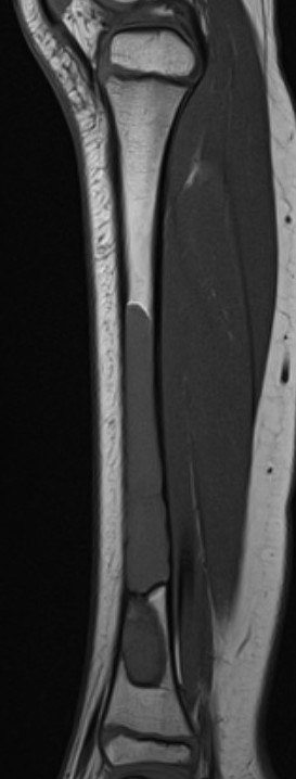 UBC tibia MRI 2