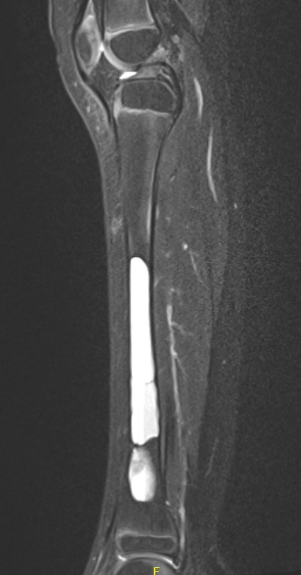 UBC tibia MRI 3