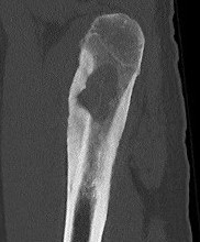 Osteoblastoma CT 1