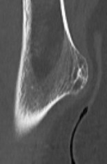 Osteochondroma humerus