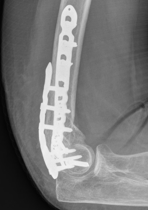 Elbow orthogonal plates 2