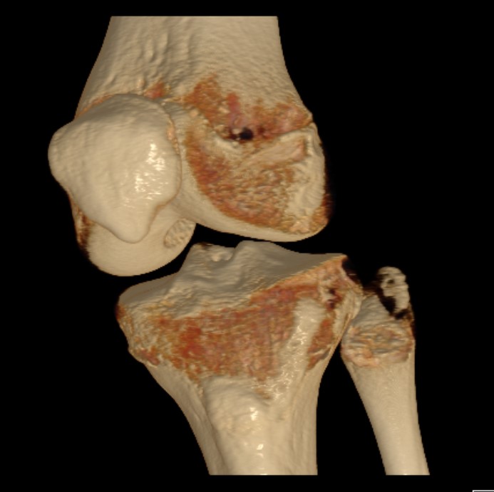 Fibula head avulsion