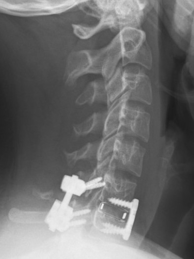 Anterior posterior fixation 2