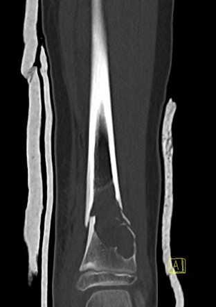 CT ankle UBC 2