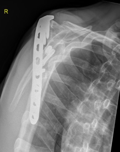 Shoulder arthrodesis lateral