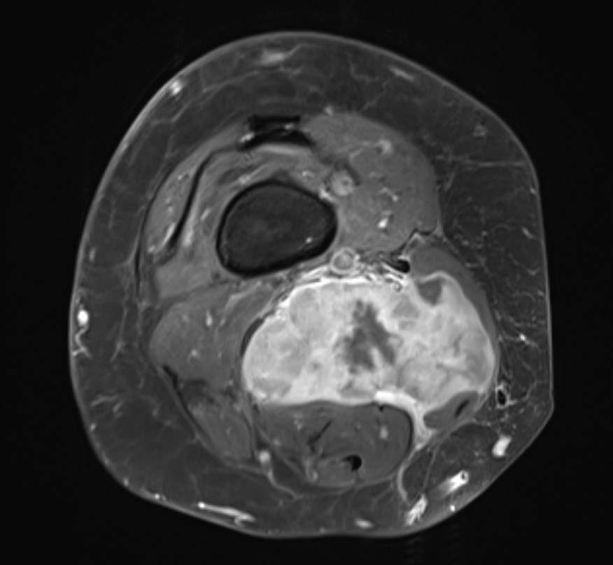 Sarcoma 2