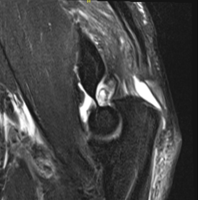 MRI triceps avulsion 1