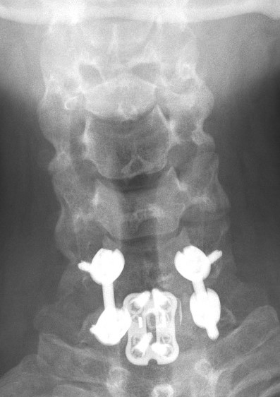 Anterior posterior fixation 1