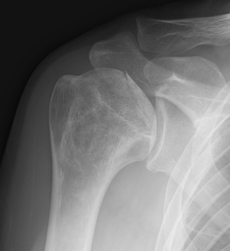 Shoulder AVN xray