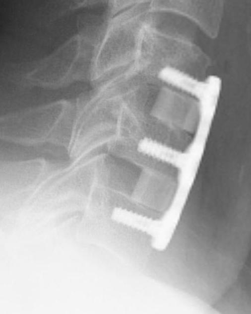 Stenosis ACDF