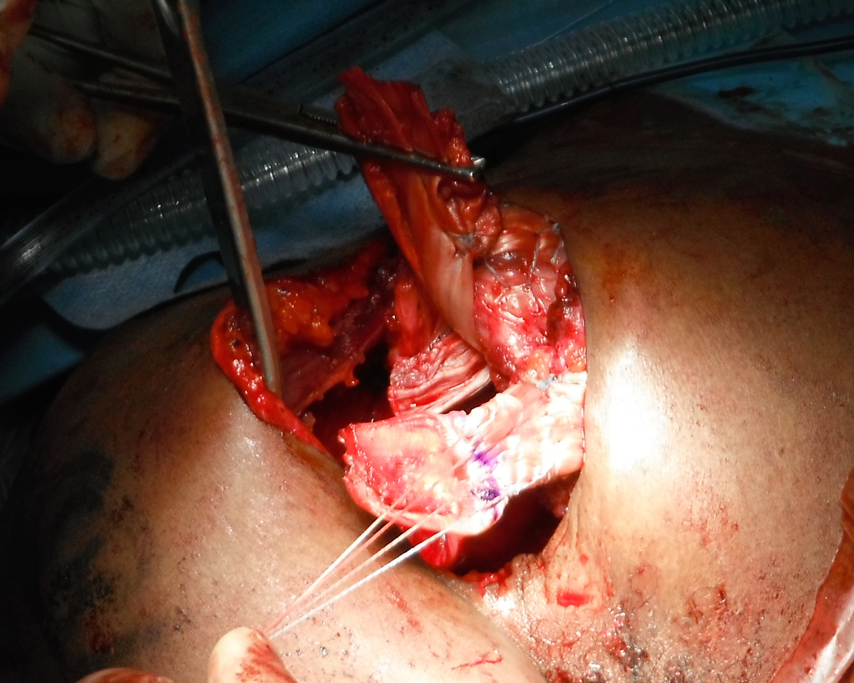 4 Suturing allograft