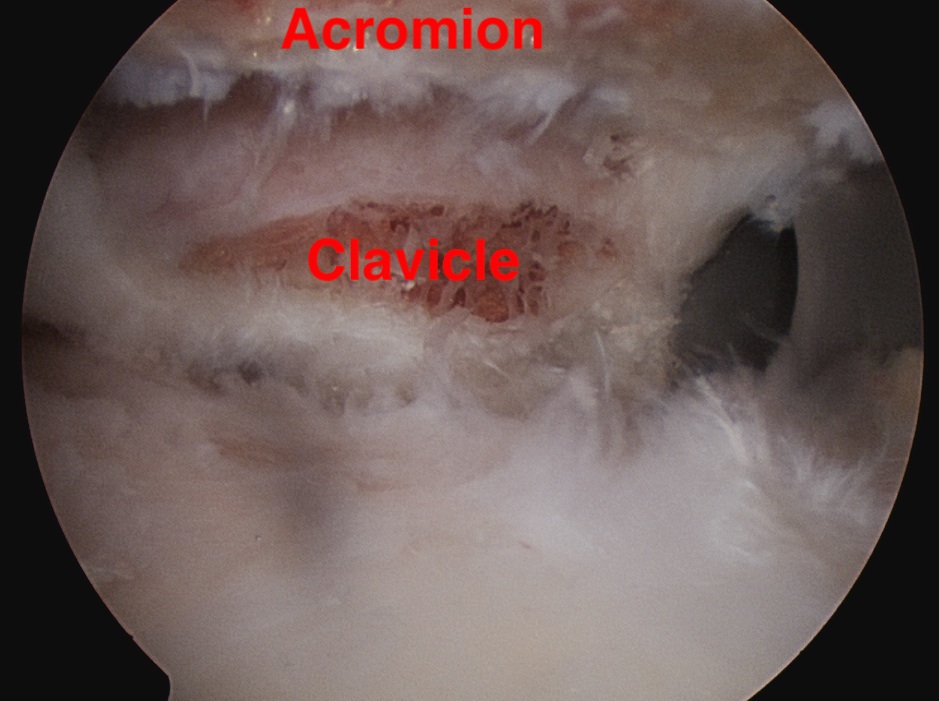 ACJ OA 3 Anterior cannula