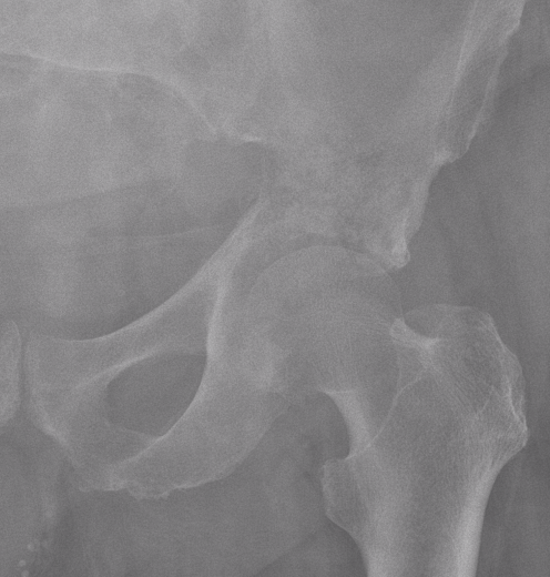 Pelvic CS xray