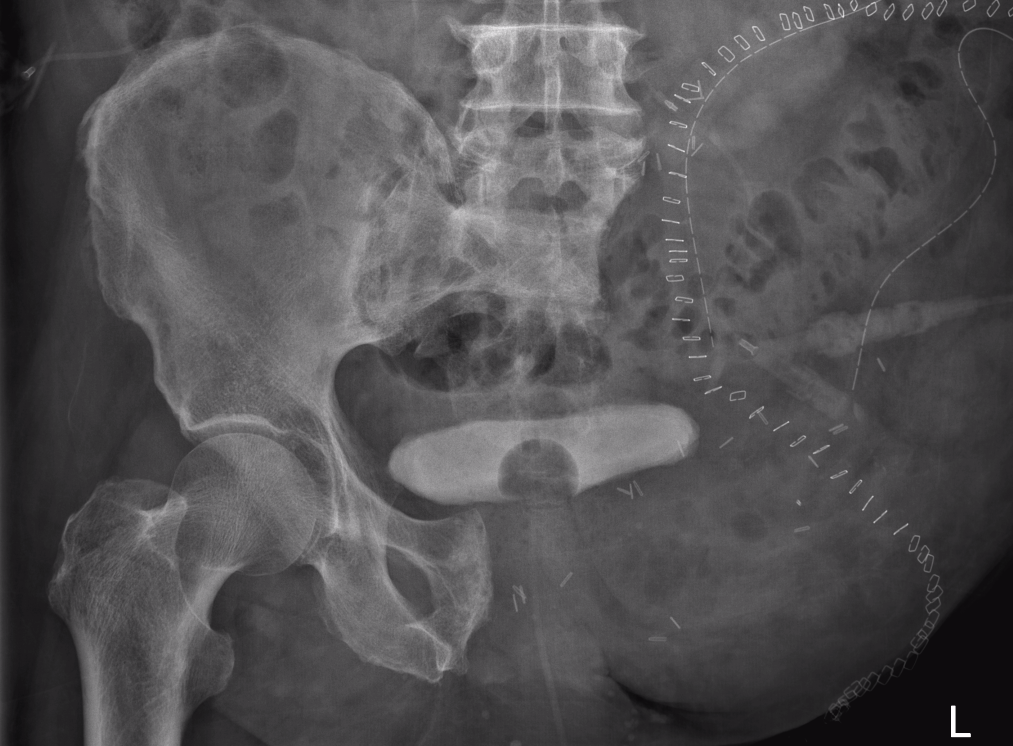 Pelvic CS postop