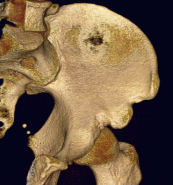 ASIS subspine impingement