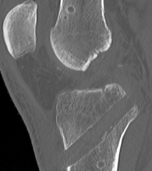 PCL transtibial