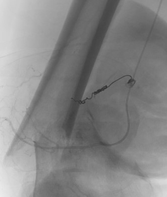 RCC femur 2