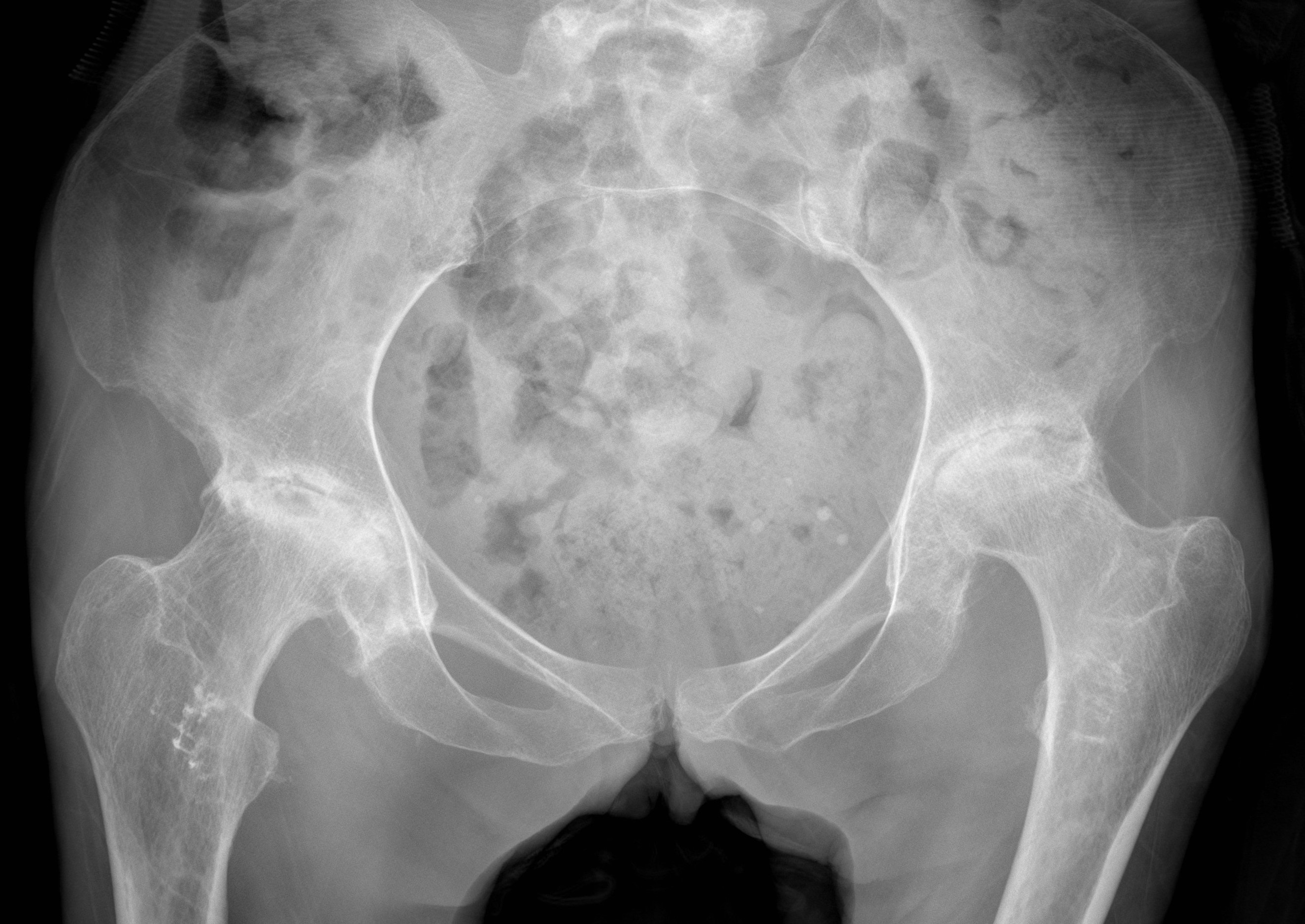 Bilateral hip AVN